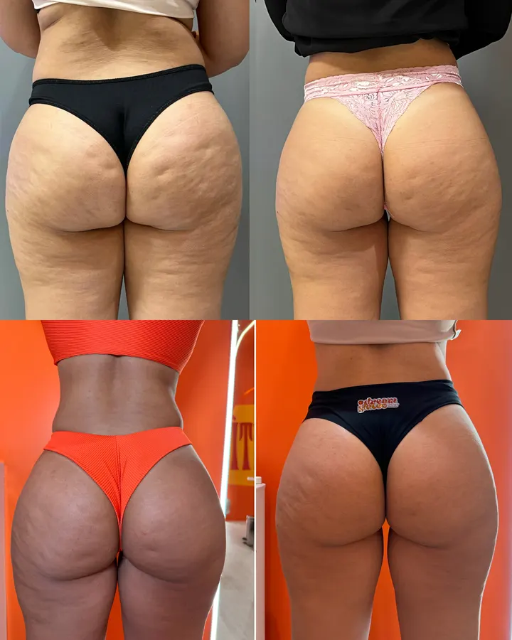 Antes e depois real com melhora da aparência da celulite