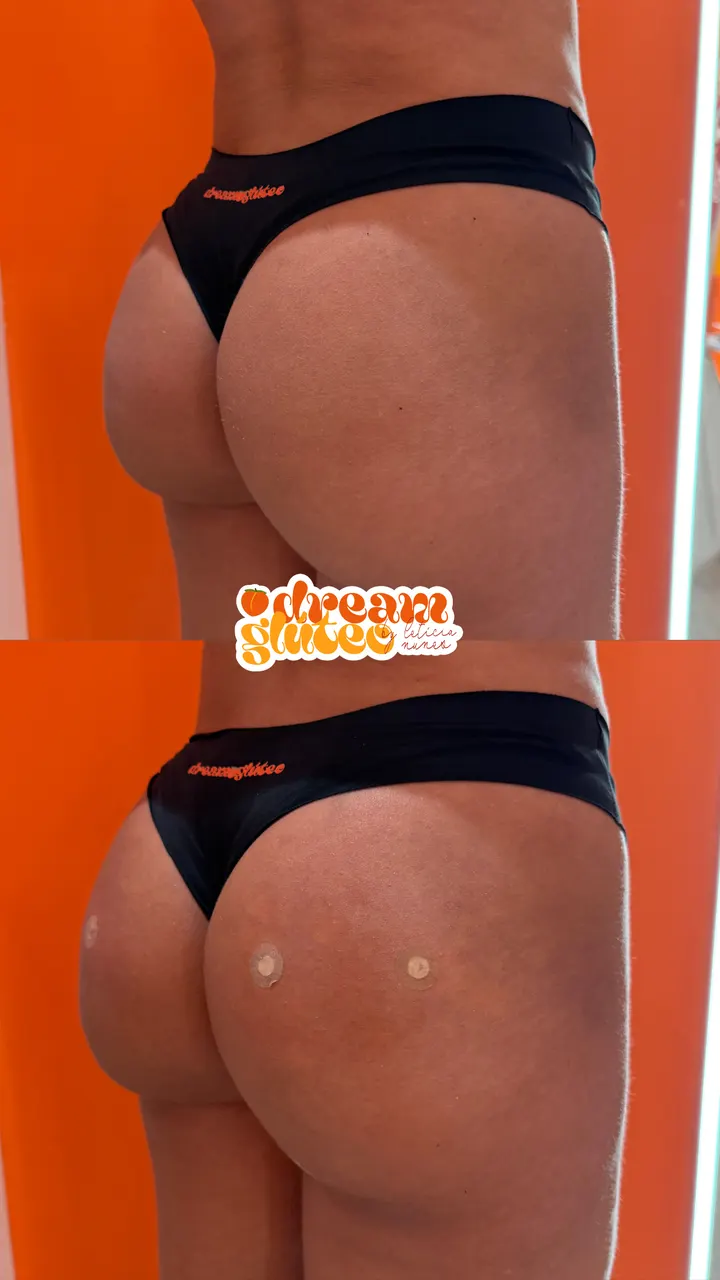Resultado real do protocolo DreamGlúteo para melhora do contorno